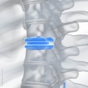 3D-Röntgengerät erspart erneute OP